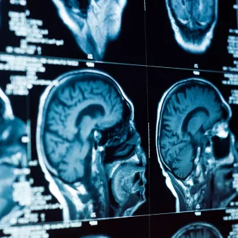 Multiple MRI scans of a human brain displayed on a monitor, showing side profiles of the brain's structures in high detail.